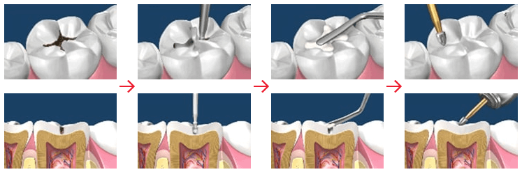 어금니 충치치료 (레진치료 방법)