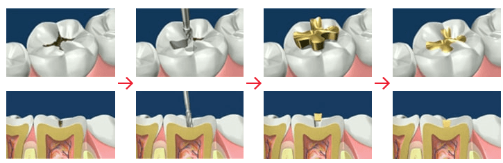 어금니 충치치료 (인레이치료 방법)