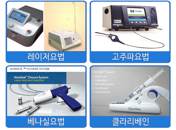 하지정맥류 수술 처치방법 4가지