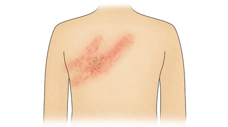 등에 발병한 대상포진 사례