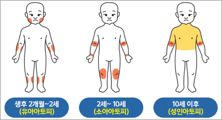 유아 아토피 피부염 증상