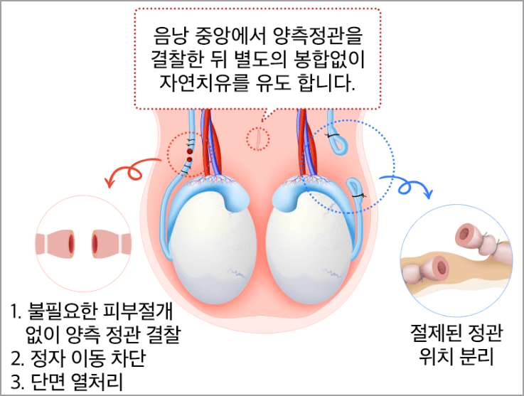 정관수술 과정