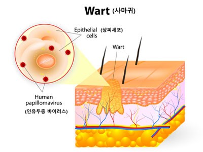 곤지름 원인 바이러스 (인유두종)