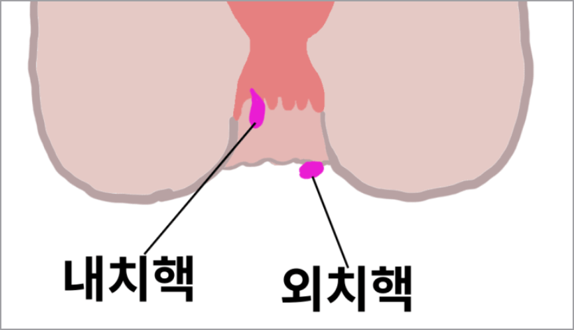 내치질과 외치질 차이점 보기