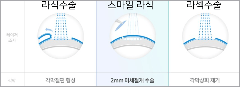 라식, 라섹 수술 차이점