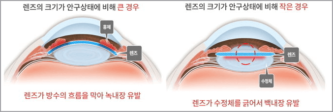 렌즈삽입술 부작용 (녹내장, 백내장 사례)