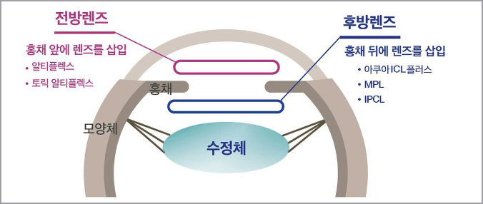 노안 교정술 인공렌즈 삽입 유형