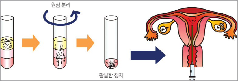 난임 시술 방법 (인공수정)