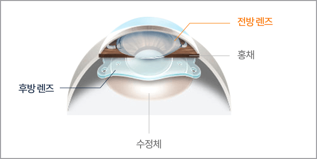 전방렌즈 후방렌즈 시술 차이점