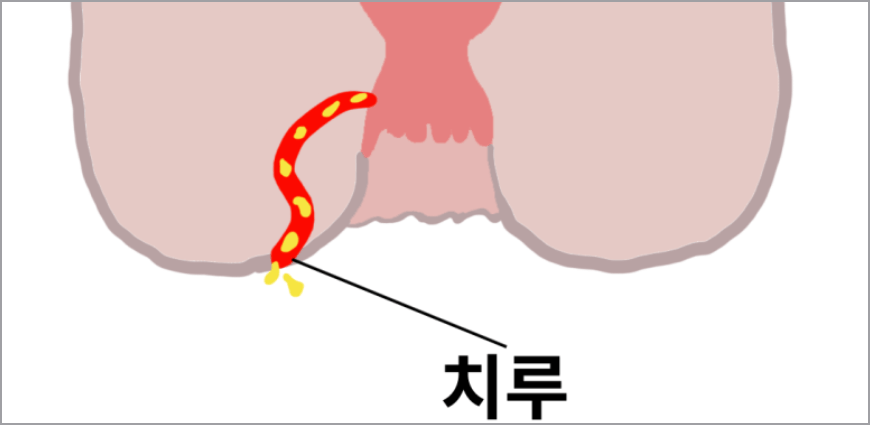 치루 증상