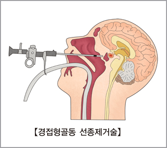 쿠싱증후군 원인인 선종제거술 모습