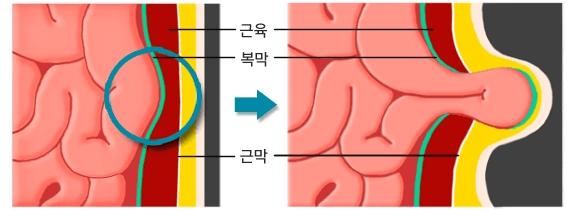 탈장 원인인 장의 탈출 증상