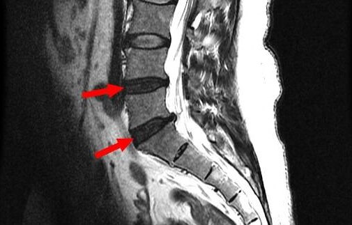 허리디스크 증상 MRI 사진